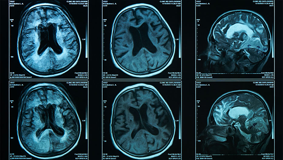 A brain scan on magnetic resonance imaging MRI film, for neurological medical diagnosis of brain diseases like FTLD and Alzheimers, which can lead to PPA