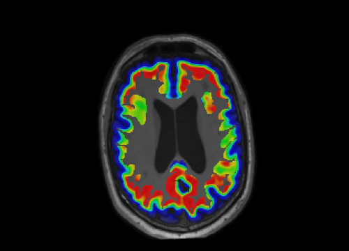 Ta PET Imaging predics cgniive decline in PPA